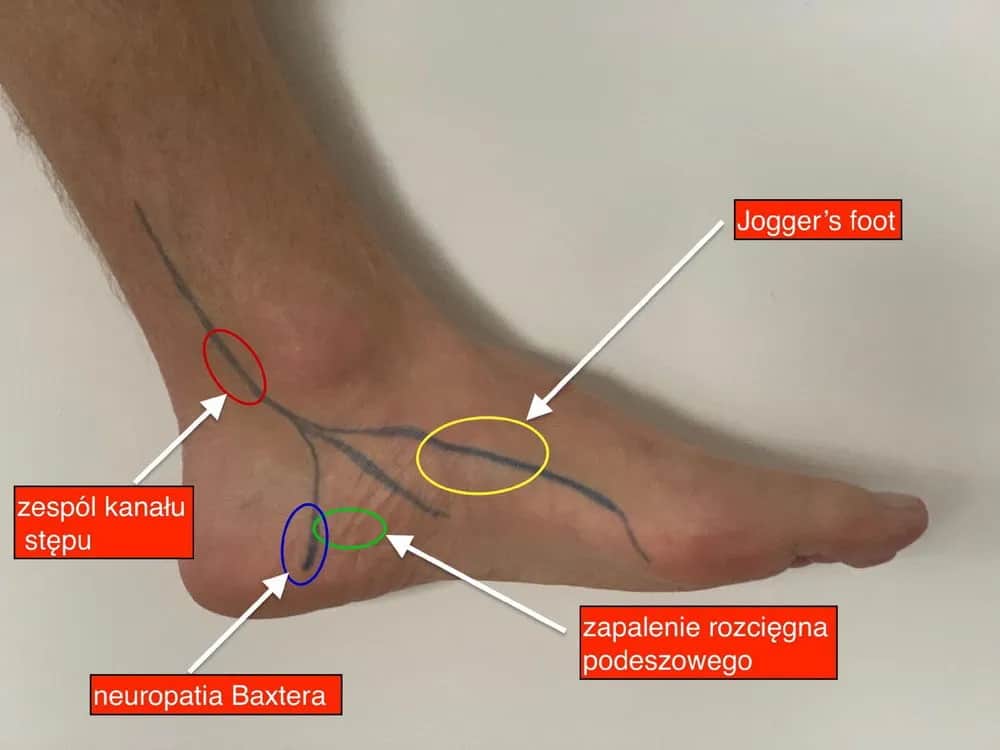 Ból pięty u biegacza jak go pokonać i biegać bez kontuzji?